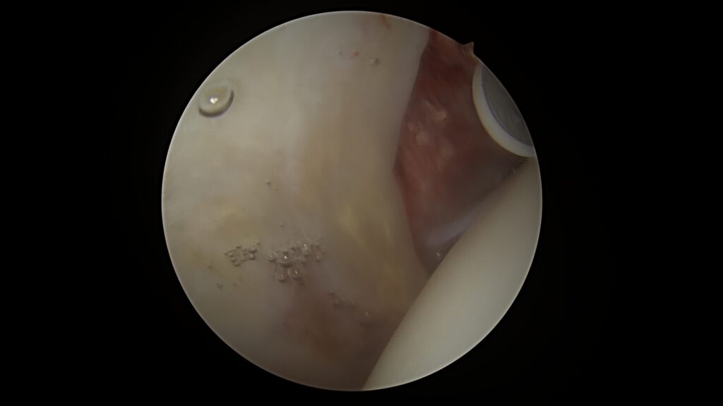 tejado adriana 37008922 arthroscopy 2025 09 05 081401 surgeon still 003 2 tejado adriana 37008922 arthroscopy 2025 09 05 081401 surgeon still 003 2